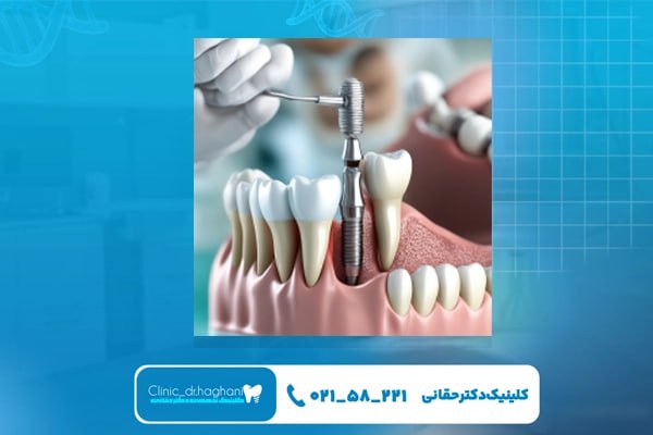 مراحل کاشت ایمپلنت دندان فوری