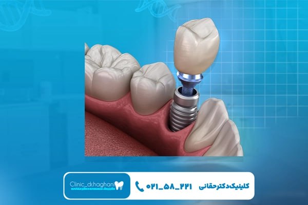 مراقبتهای روزهای اول تا یک هفته بعد از ایمپلنت دندان مراقبتهای روزهای اول تا یک هفته بعد از ایمپلنت دندان