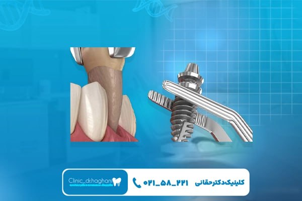 راز موفقیت کاشت ایمپلنت دندان در دورههای مراقبتی راز موفقیت کاشت ایمپلنت دندان در دورههای مراقبتی