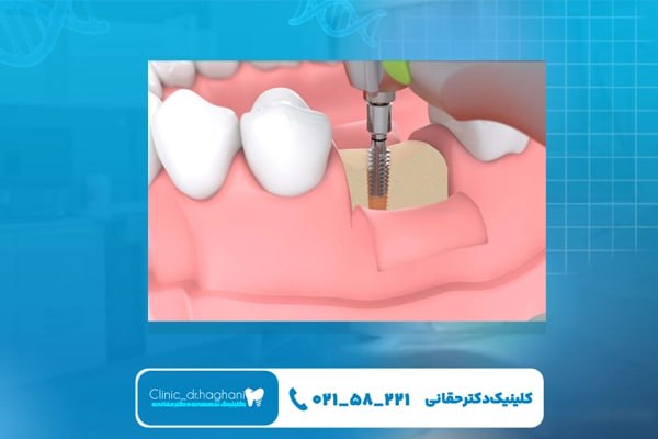 ایمپلنت بدون بخیه در تهران