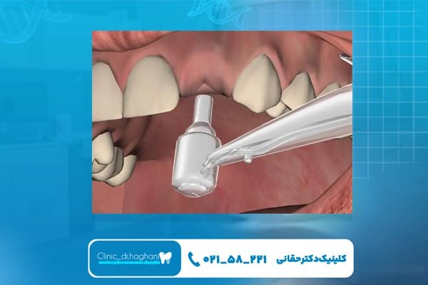 کاشت دندان بدون بخیه با روش پانچ