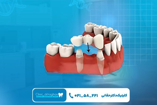 خدمات ایمپلنت بدون بخیه در کلینیک دندانپزشکی دکتر حقانی