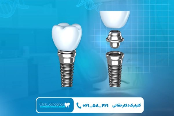 مدت زمان بهبودی بعد از ایمپلنت
