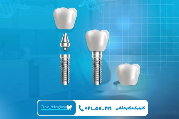 مراقبت‌های لازم در مدت زمان بهبودی بعد از ایمپلنت