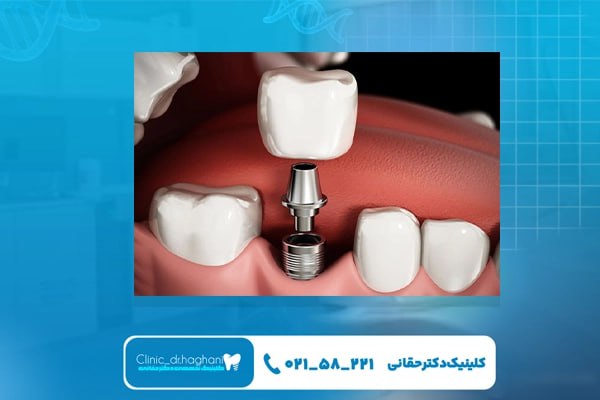 چرا ایمپلنت بهترین روش جایگزینی دندان است؟