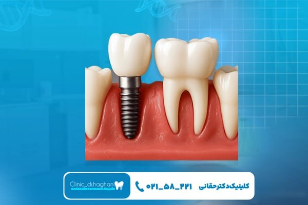 تفاوت انواع ایمپلنت دندان