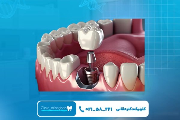 قیمت ایمپلنت دندان یک روزه قیمت ایمپلنت دندان یک روزه