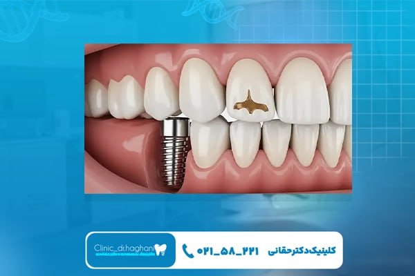 ایمپلنت دندان یک روزه چگونه انجام می شود؟ ایمپلنت دندان یک روزه چگونه انجام می شود؟