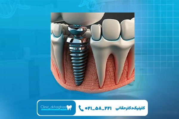 مراحل انجام ایمپلنت دندان یک روزه مراحل انجام ایمپلنت دندان یک روزه