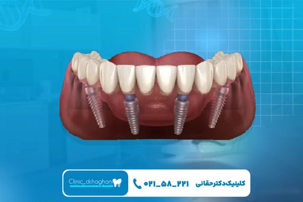 هزینه ایمپلنت دندان جلو در تهران