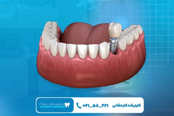 مراحل ایمپلنت‌ دندان جلو و تاثیر آن بر هزینه