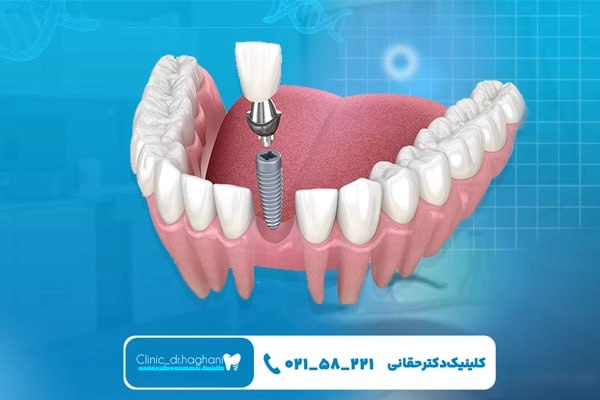 انواع ایمپلنت مناسب دندان جلو