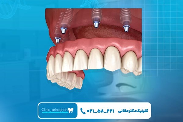 هزینه ایمپلنت کامل فک بالا