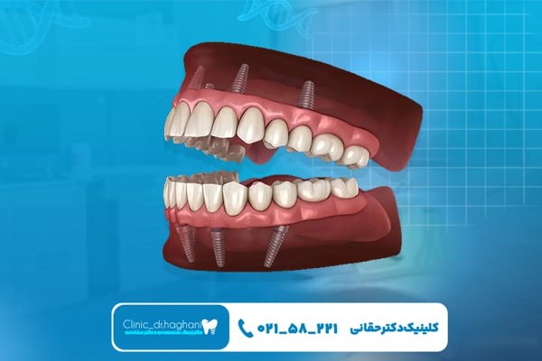 هزینه ایمپلنت دندان فک بالا