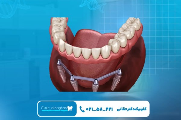 هزینه ایمپلنت کامل فک پایین