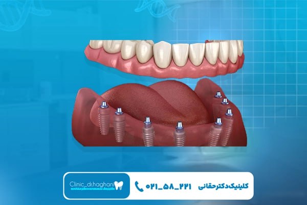 چه اشخاصی برای ایمپلنت کامل فک پایین مناسب هستند