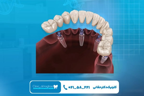 هزینه ایمپلنت کامل فک پایین