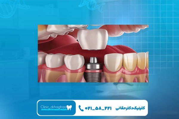دلایل انتخاب کاشت دیجیتال در کلینیک دندانپزشکی دکتر حقانی دلایل انتخاب کاشت دیجیتال در کلینیک دندانپزشکی دکتر حقانی