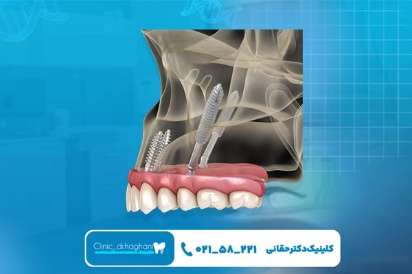 چه افرادی نباید از ایمپلنت دیجیتال استفاده کنند؟ چه افرادی نباید از ایمپلنت دیجیتال استفاده کنند؟