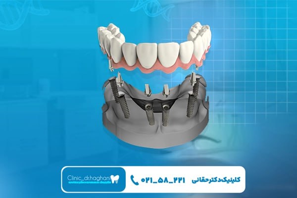 چه افرادی باید از ایمپلنت دیجیتال استفاده کنند؟ چه افرادی باید از ایمپلنت دیجیتال استفاده کنند؟