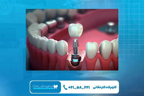 ایمپلنت دندان برای سالمندان ایمپلنت دندان برای سالمندان