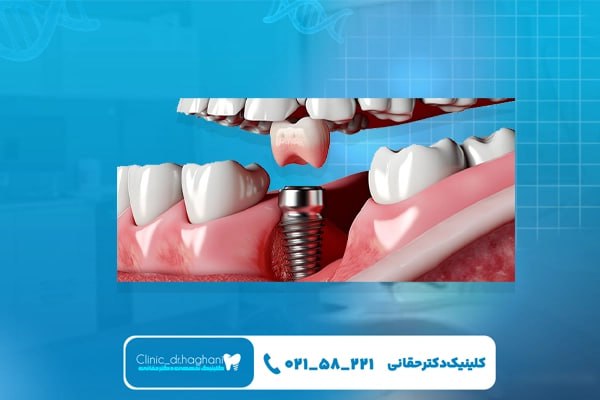 خطرات احتمالی ایمپلنت دندان برای افراد مسن خطرات احتمالی ایمپلنت دندان برای افراد مسن