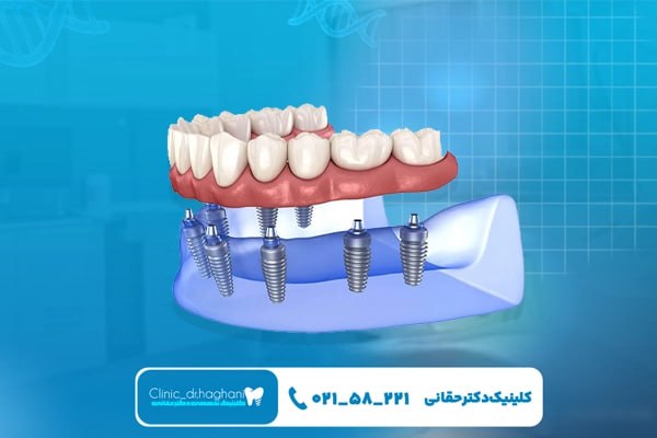 کاشت ایمپلنت دندان برای سالمندان با خدمات کلینیک دندانپزشکی دکتر حقانی کاشت ایمپلنت دندان برای سالمندان با خدمات کلینیک دندانپزشکی دکتر حقانی