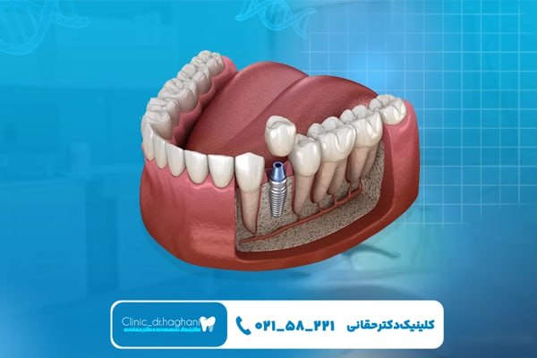 نکات مهم ایمپلنت‌ دندان برای افراد دیابتی