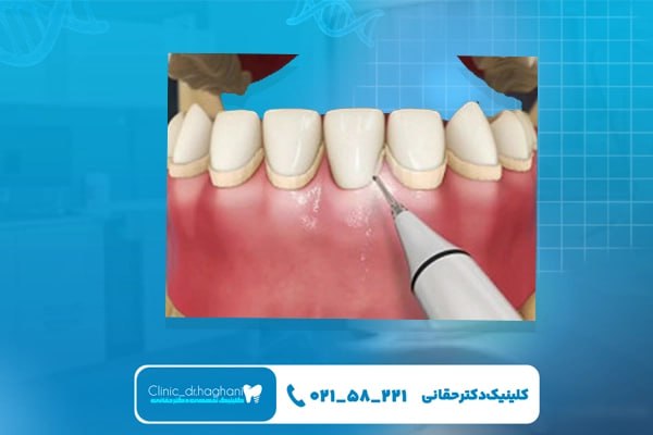 خدمات زیبایی دندان برای لبخندی جذاب و زیبا خدمات زیبایی دندان برای لبخندی جذاب و زیبا