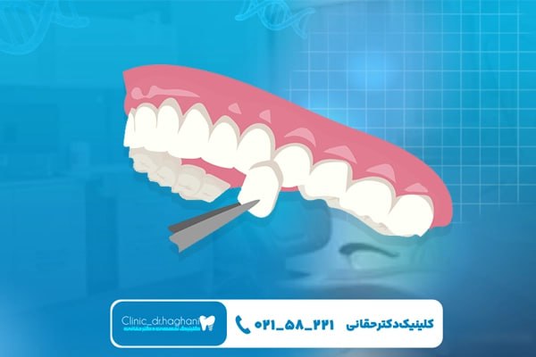 تجربه درمانی حرفهای در کلینیک دندانپزشکی دکتر حقانی تجربه درمانی حرفهای در کلینیک دندانپزشکی دکتر حقانی