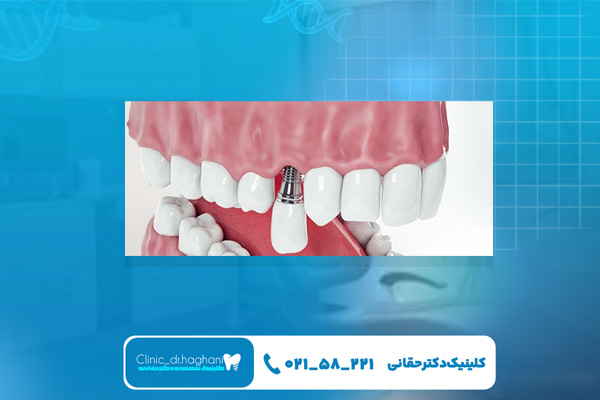 ایمپلنت تک دندان ایمپلنت تک دندان