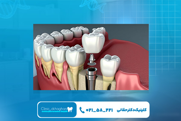 مزیتهای ایمپلنت تک دندان مزیتهای ایمپلنت تک دندان