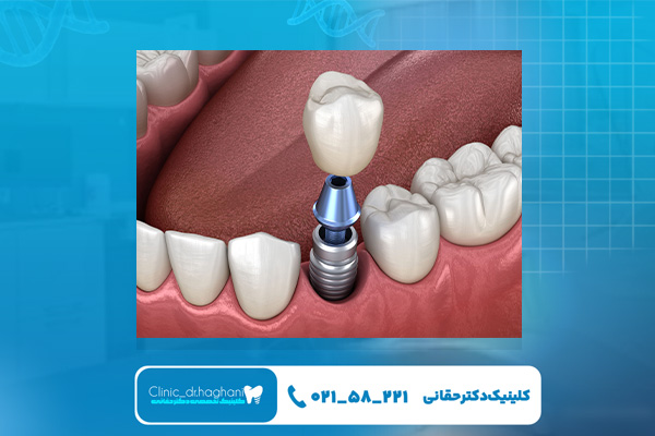 انجام کاشت ایمپلنت تک دندان در کلینیک دندانپزشکی دکتر حقانی انجام کاشت ایمپلنت تک دندان در کلینیک دندانپزشکی دکتر حقانی