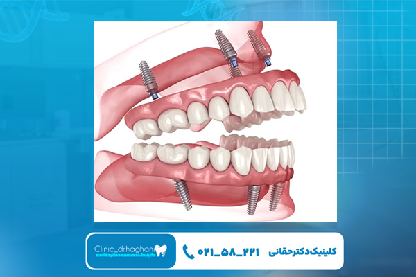 ایمپلنت کامل دهان ایمپلنت کامل دهان