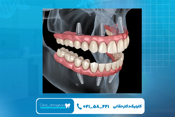 شیوه کاشت ایمپلنت کامل دهان در یک روز شیوه کاشت ایمپلنت کامل دهان در یک روز