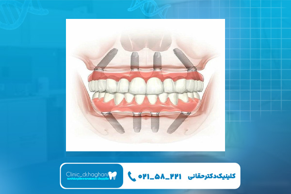 افراد واجد شرایط برای ایمپلنت کامل دهان افراد واجد شرایط برای ایمپلنت کامل دهان
