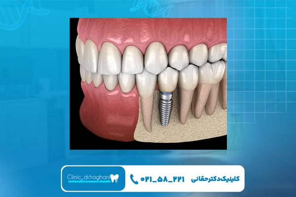 ایمپلنت در جردن تهران ایمپلنت در جردن تهران