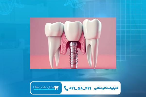 دندانپزشکی ایمپلنت در جردن تهران دندانپزشکی ایمپلنت در جردن تهران