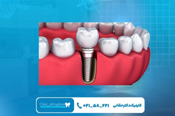 مراحل انجام ایمپلنت دندان مراحل انجام ایمپلنت دندان