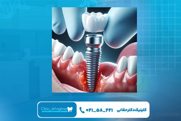 مراحل انجام ایمپلنت دندان مراحل انجام ایمپلنت دندان