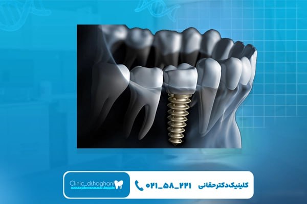 مراحل انجام ایمپلنت دندان مراحل انجام ایمپلنت دندان