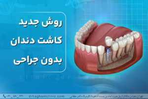 روش جدید کاشت دندان بدون جراحی