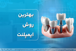 بهترین روش ایمپلنت