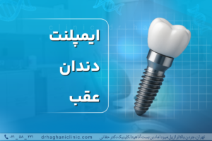 ایمپلنت دندان عقب