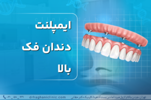 ایمپلنت دندان فک