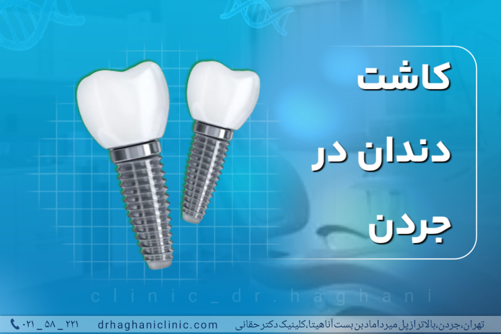 کاشت دندان در جردن