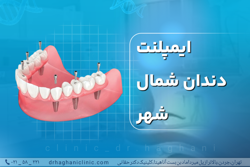 ایمپلنت دندان شمال شهر