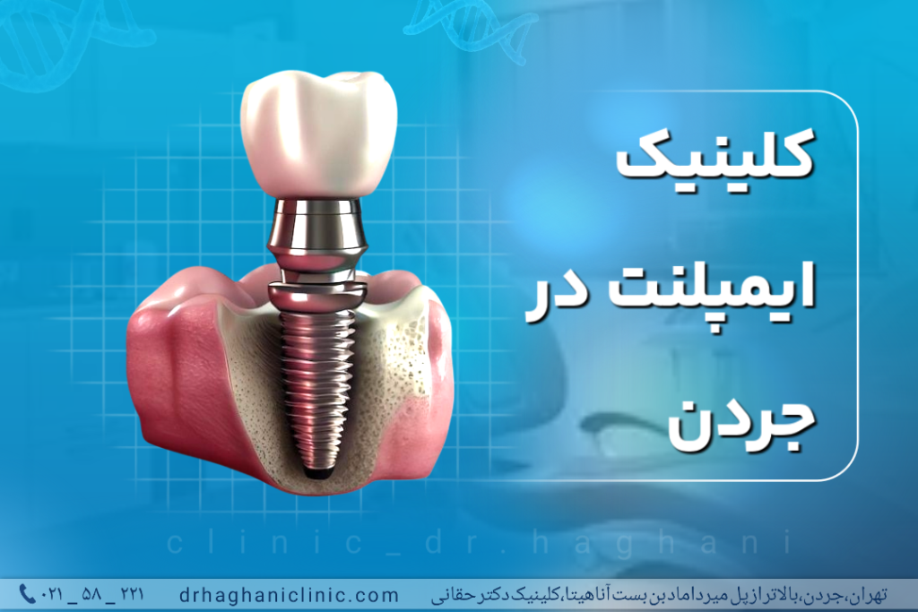 کلینیک ایمپلنت دندان در جردن