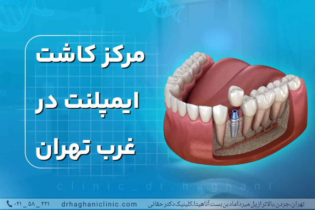 مرکز کاشت ایمپلنت در غرب تهران