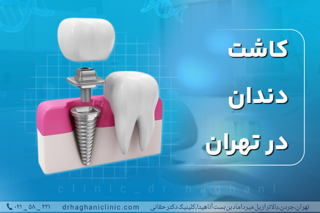 کاشت دندان درتهران